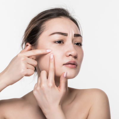 acne rosacea clinica sarabia